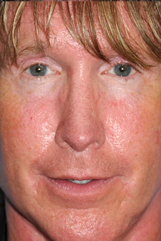 Rhinoplasty Before & After Gallery - Patient 241581 - Image 2