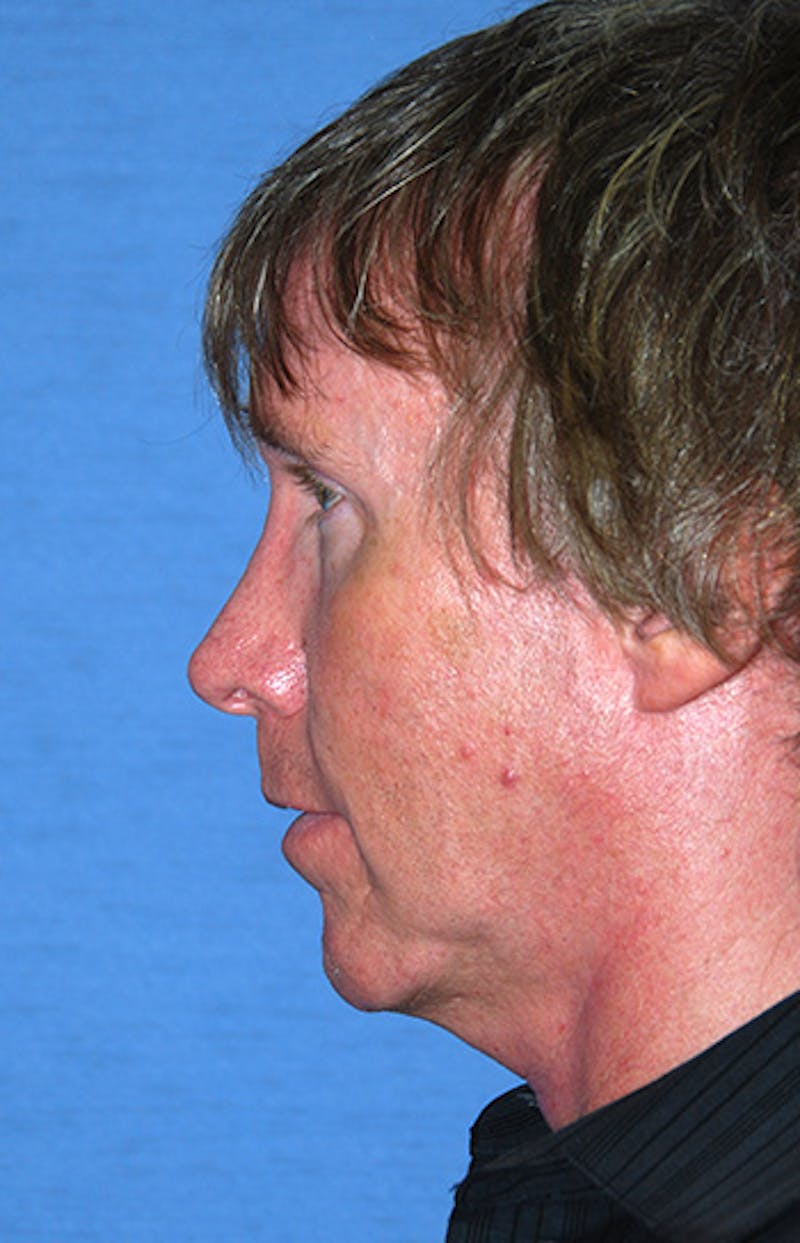 Rhinoplasty Before & After Gallery - Patient 241581 - Image 3