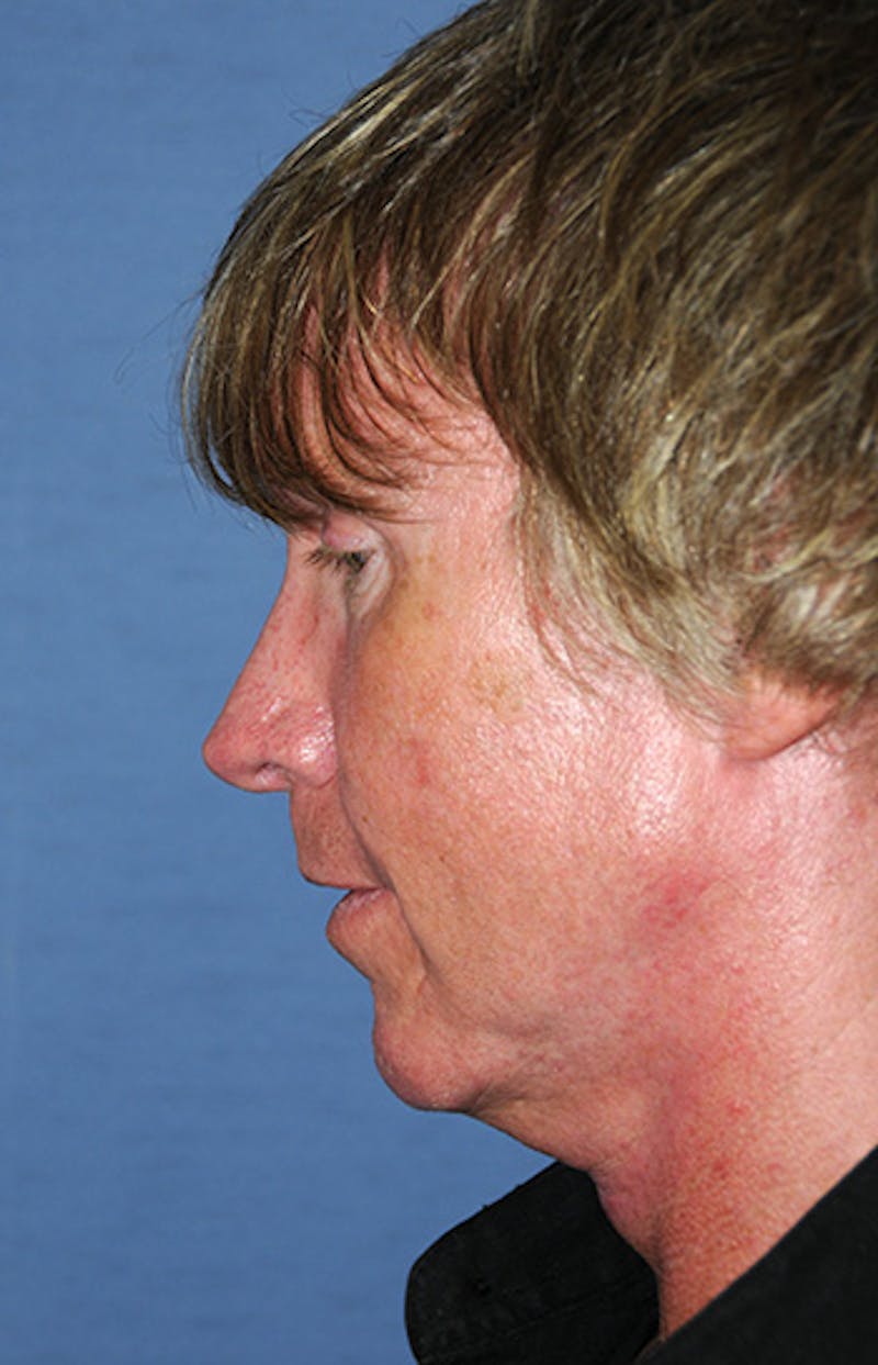 Rhinoplasty Before & After Gallery - Patient 241581 - Image 4