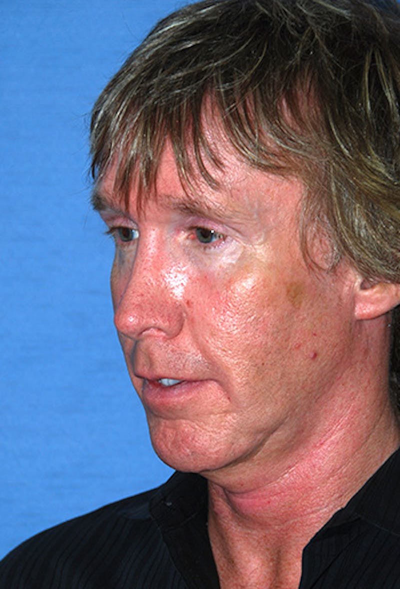 Rhinoplasty Before & After Gallery - Patient 241581 - Image 5