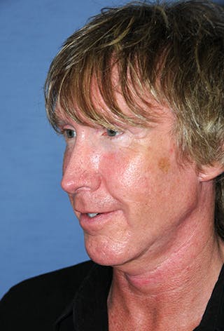 Rhinoplasty Before & After Gallery - Patient 241581 - Image 6