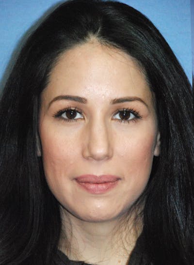 Rhinoplasty Before & After Gallery - Patient 362262 - Image 1