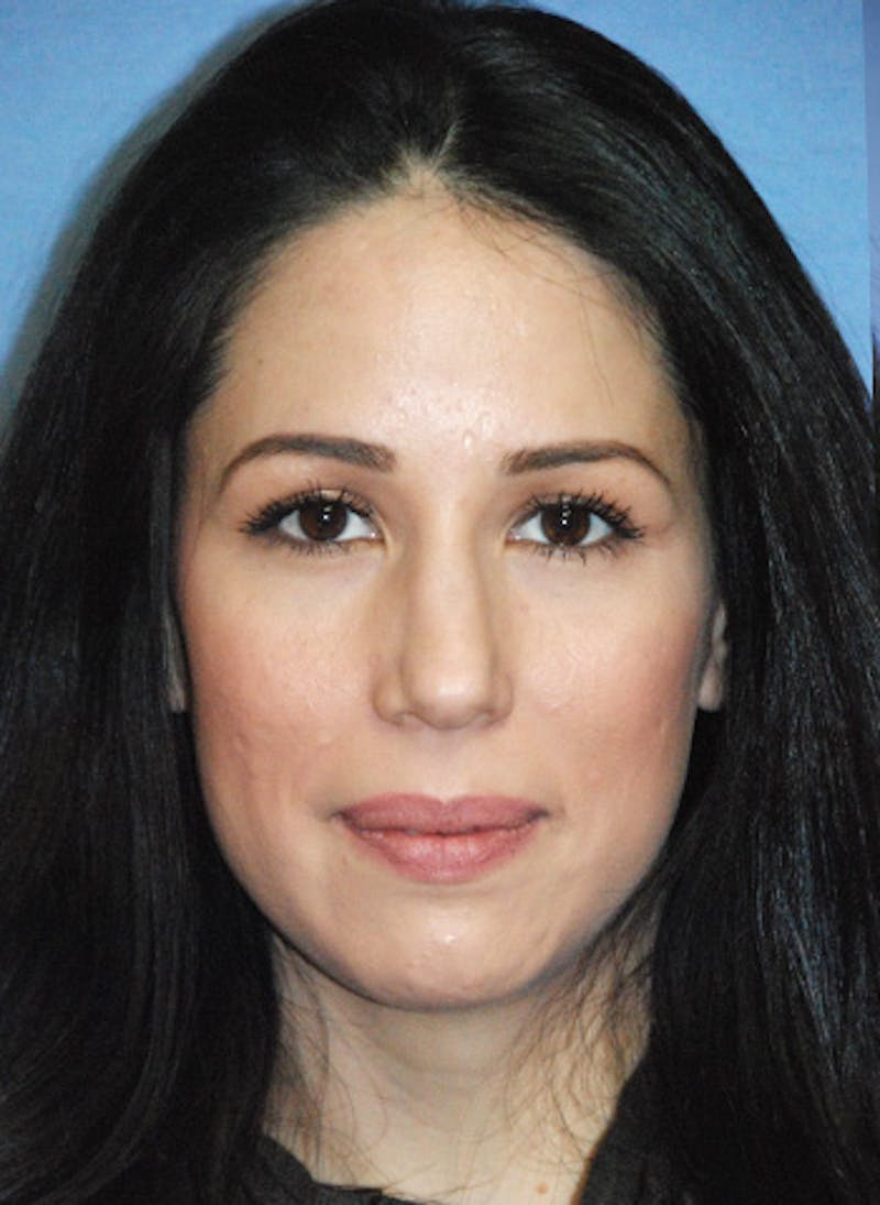 Rhinoplasty Before & After Gallery - Patient 362262 - Image 1