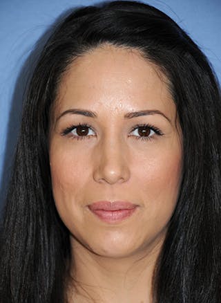 Rhinoplasty Before & After Gallery - Patient 362262 - Image 2