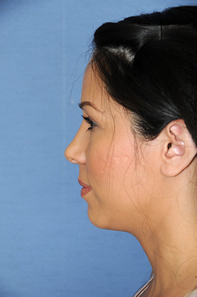 Rhinoplasty Before & After Gallery - Patient 362262 - Image 4