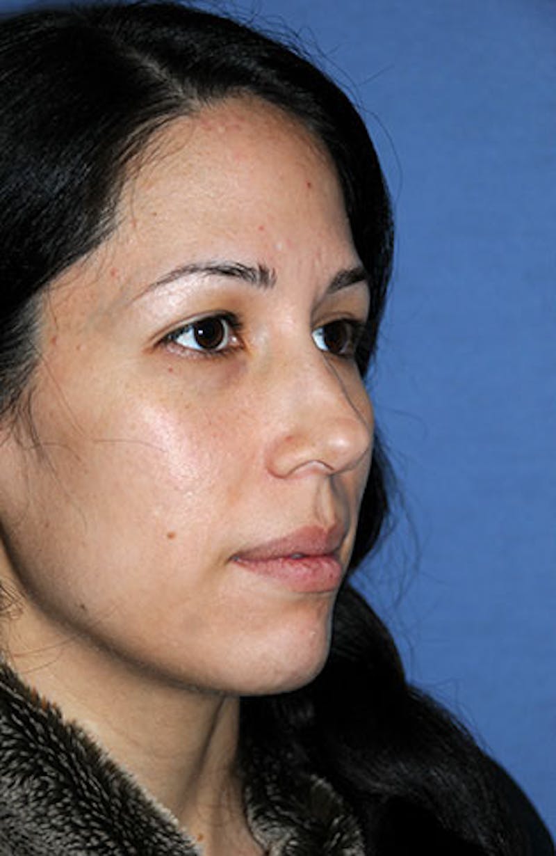 Rhinoplasty Before & After Gallery - Patient 362262 - Image 5