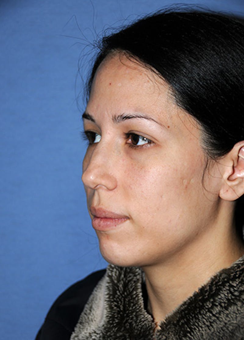 Rhinoplasty Before & After Gallery - Patient 362262 - Image 7