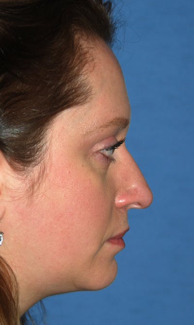 Rhinoplasty Before & After Gallery - Patient 398323 - Image 1