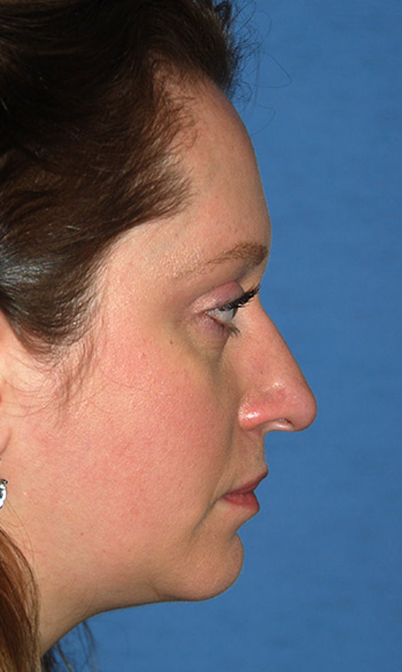 Rhinoplasty Before & After Gallery - Patient 398323 - Image 1