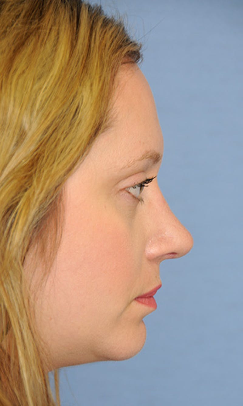 Rhinoplasty Before & After Gallery - Patient 398323 - Image 2