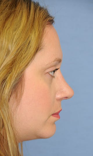 Rhinoplasty Before & After Gallery - Patient 398323 - Image 2