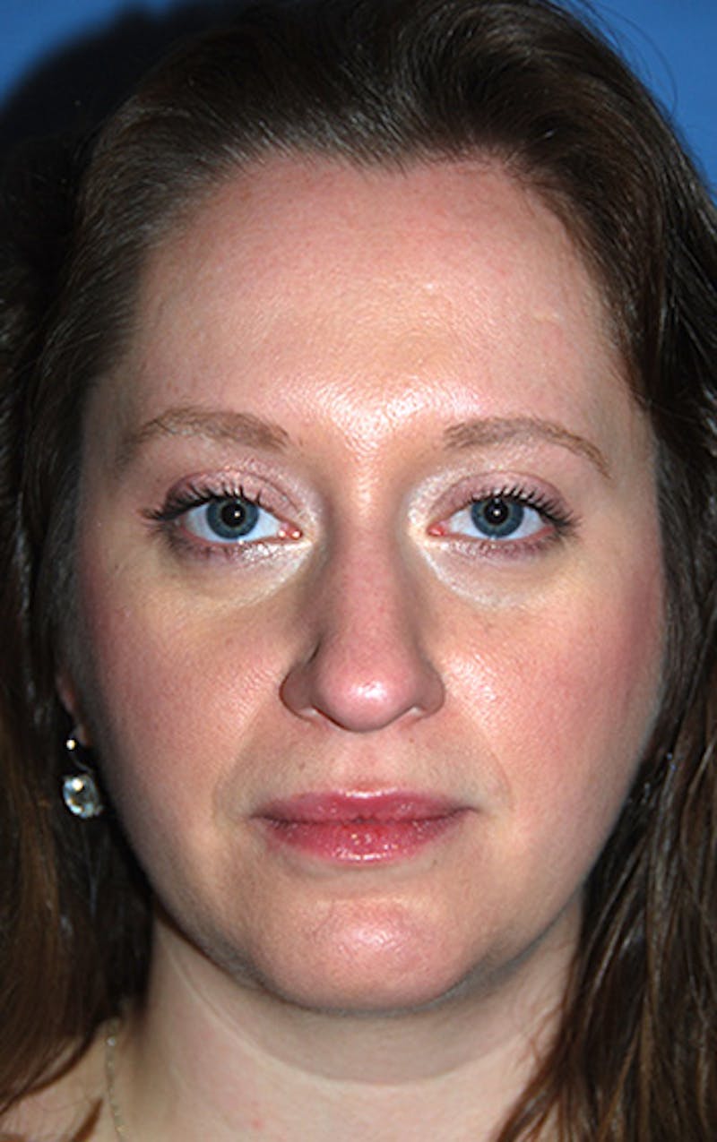 Rhinoplasty Before & After Gallery - Patient 398323 - Image 3