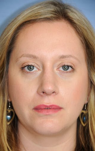 Rhinoplasty Before & After Gallery - Patient 398323 - Image 4