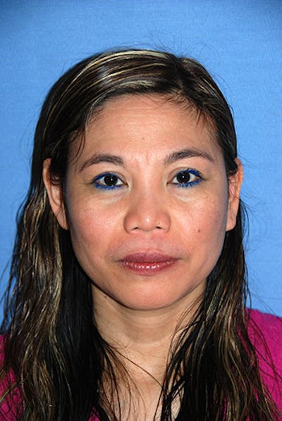 Rhinoplasty Before & After Gallery - Patient 192218 - Image 1