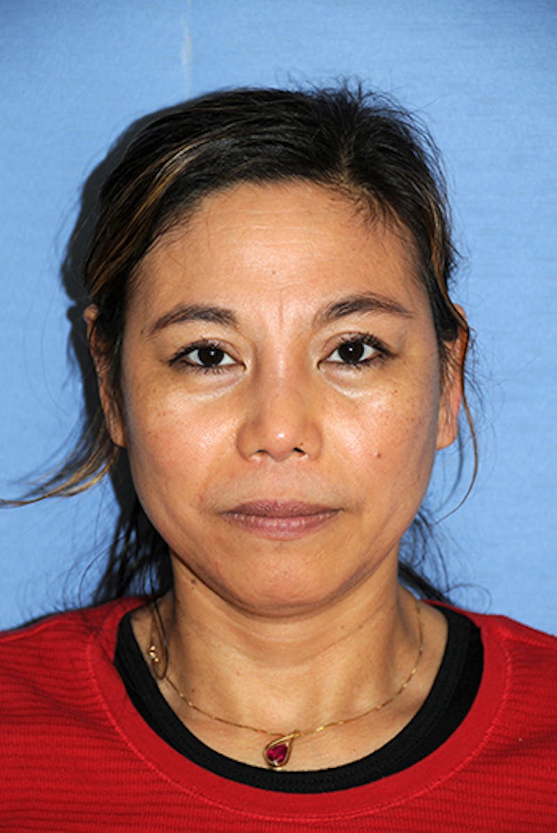 Rhinoplasty Before & After Gallery - Patient 192218 - Image 2