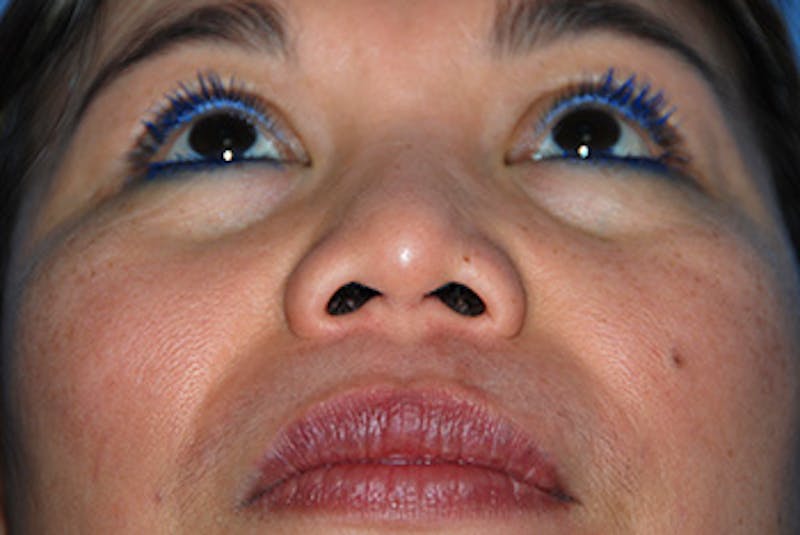 Rhinoplasty Before & After Gallery - Patient 192218 - Image 3