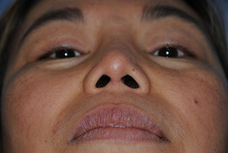 Rhinoplasty Before & After Gallery - Patient 192218 - Image 4
