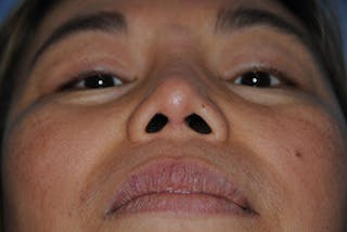 Rhinoplasty Before & After Gallery - Patient 192218 - Image 4