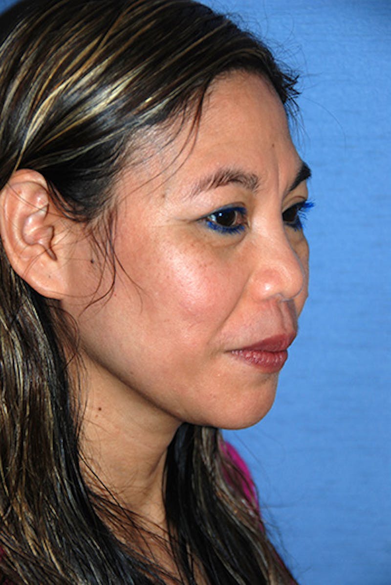 Rhinoplasty Before & After Gallery - Patient 192218 - Image 5