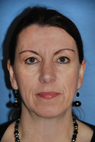 Rhinoplasty Before & After Gallery - Patient 346211 - Image 2