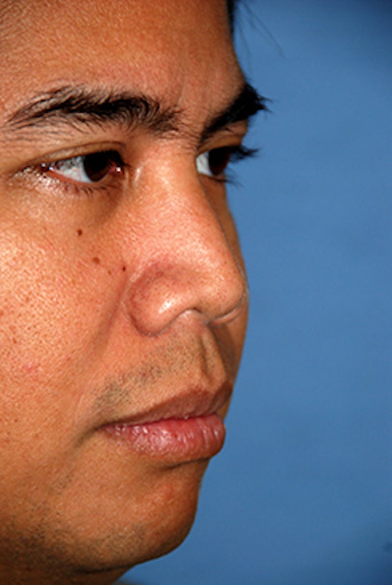 Rhinoplasty Before & After Gallery - Patient 284970 - Image 3