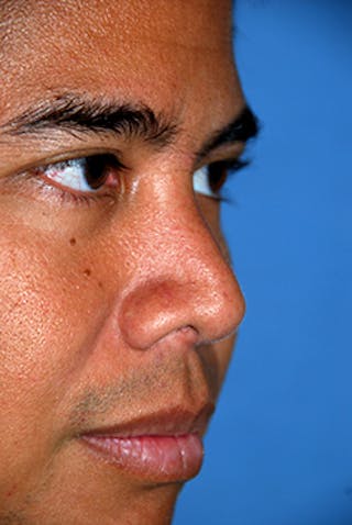 Rhinoplasty Before & After Gallery - Patient 284970 - Image 4