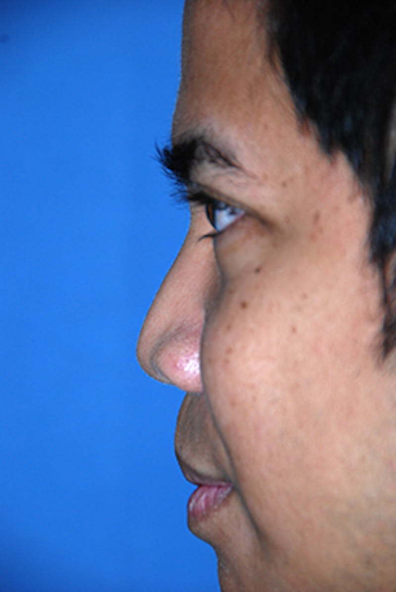 Rhinoplasty Before & After Gallery - Patient 284970 - Image 5