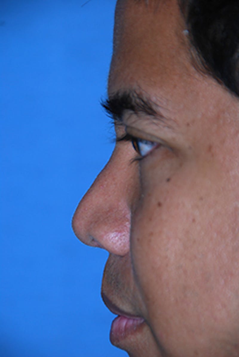 Rhinoplasty Before & After Gallery - Patient 284970 - Image 6