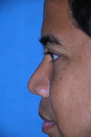 Rhinoplasty Before & After Gallery - Patient 284970 - Image 6