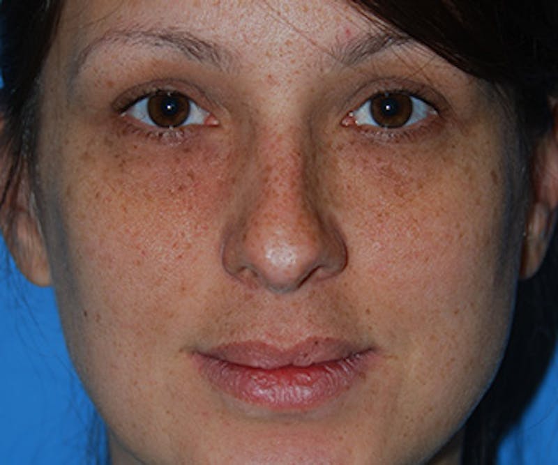 Rhinoplasty Before & After Gallery - Patient 414419 - Image 1