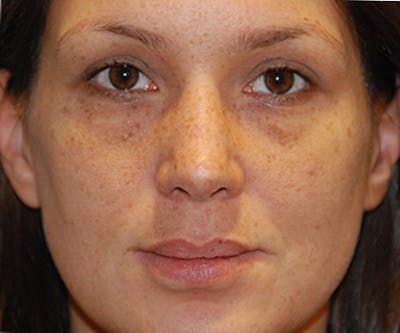 Rhinoplasty Before & After Gallery - Patient 414419 - Image 2