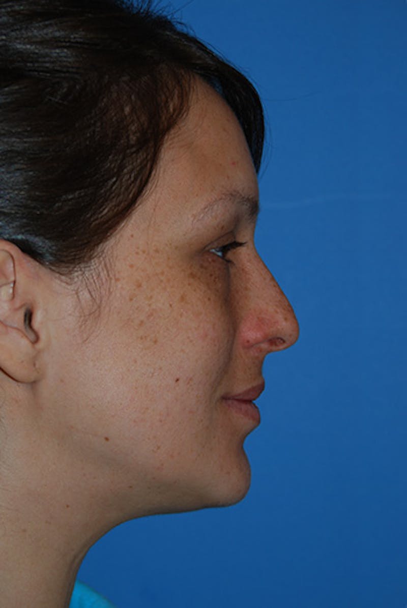 Rhinoplasty Before & After Gallery - Patient 414419 - Image 3