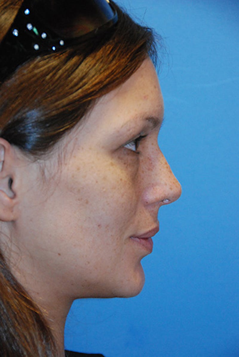 Rhinoplasty Before & After Gallery - Patient 414419 - Image 4