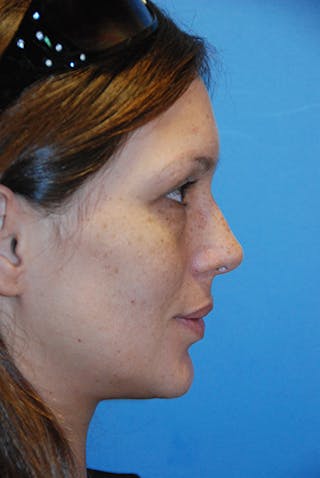 Rhinoplasty Before & After Gallery - Patient 414419 - Image 4