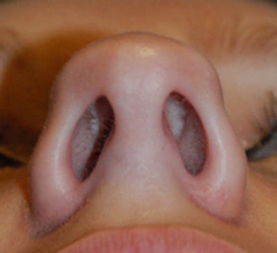 Rhinoplasty Before & After Gallery - Patient 183240 - Image 1