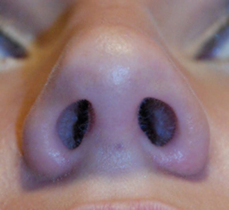 Rhinoplasty Before & After Gallery - Patient 183240 - Image 2