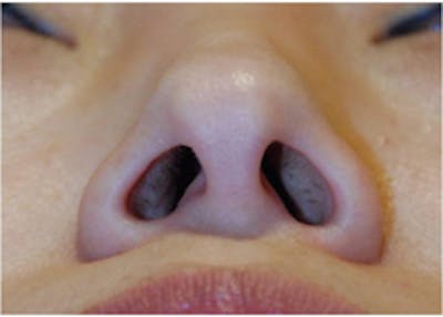 Rhinoplasty Before & After Gallery - Patient 254078 - Image 1