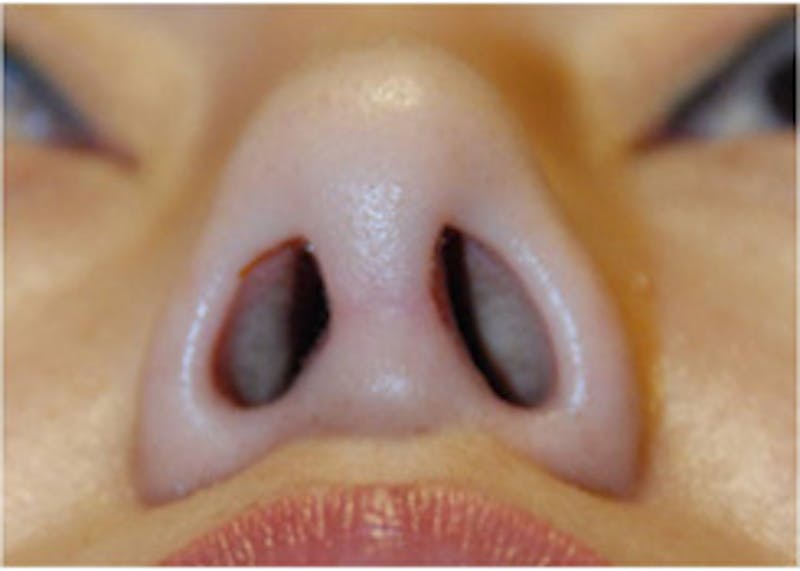 Rhinoplasty Before & After Gallery - Patient 254078 - Image 2