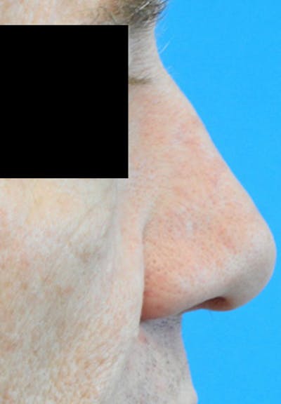 Rhinoplasty Before & After Gallery - Patient 135531 - Image 1