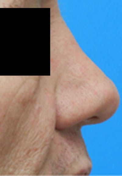 Rhinoplasty Before & After Gallery - Patient 135531 - Image 2