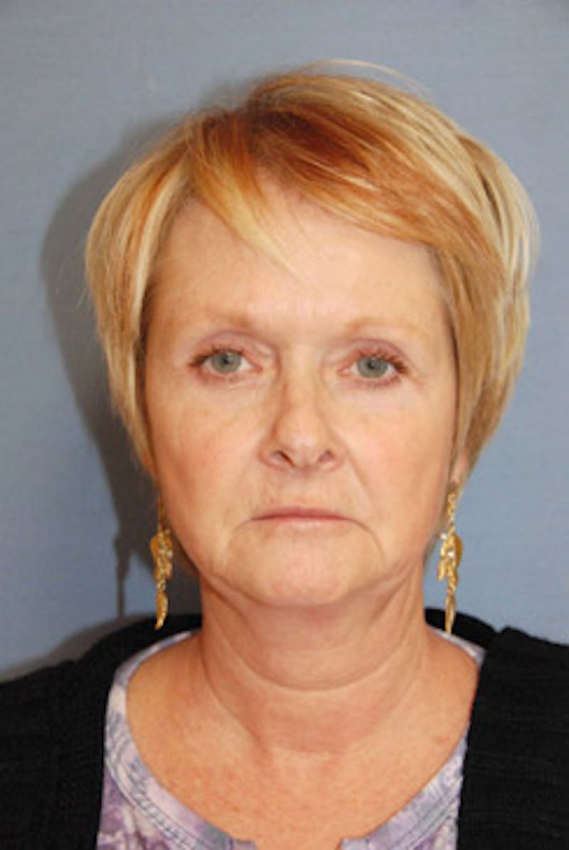 Rhinoplasty Before & After Gallery - Patient 849233 - Image 1