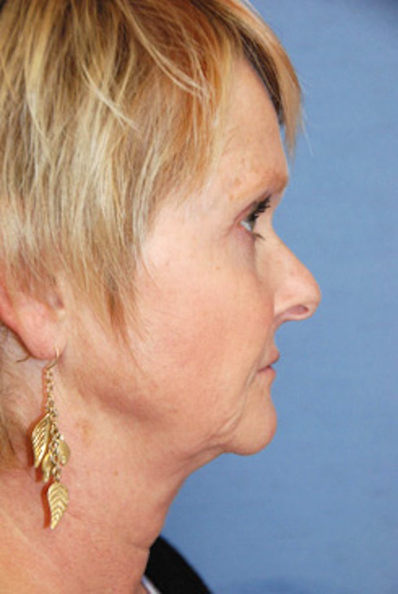 Rhinoplasty Before & After Gallery - Patient 849233 - Image 3