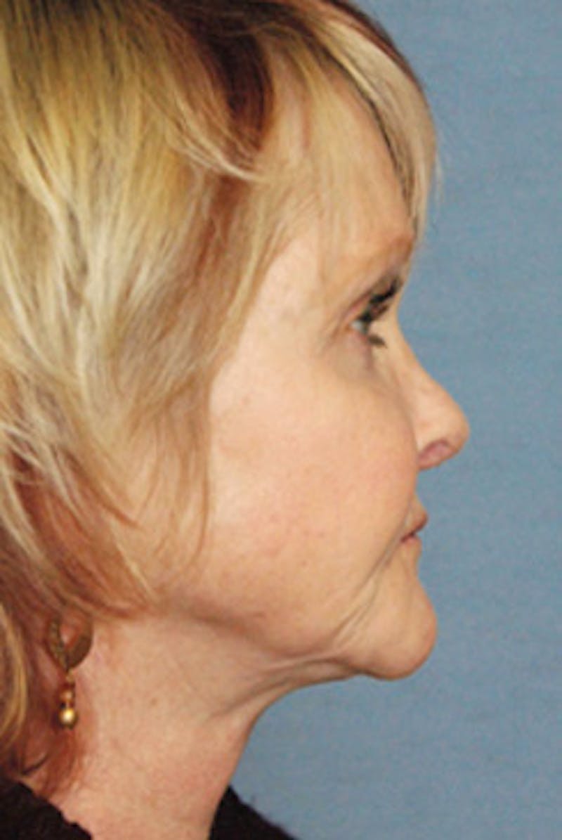 Rhinoplasty Before & After Gallery - Patient 849233 - Image 4