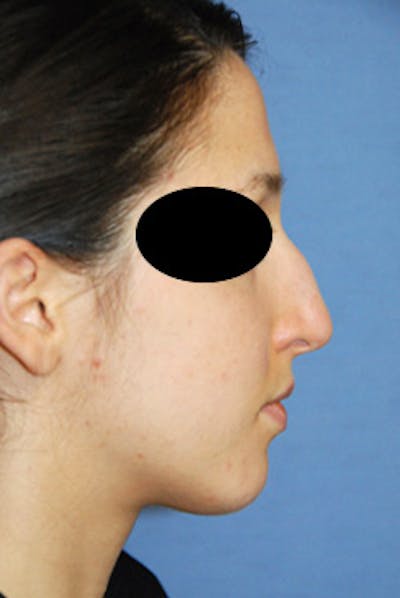 Rhinoplasty Before & After Gallery - Patient 353489 - Image 1