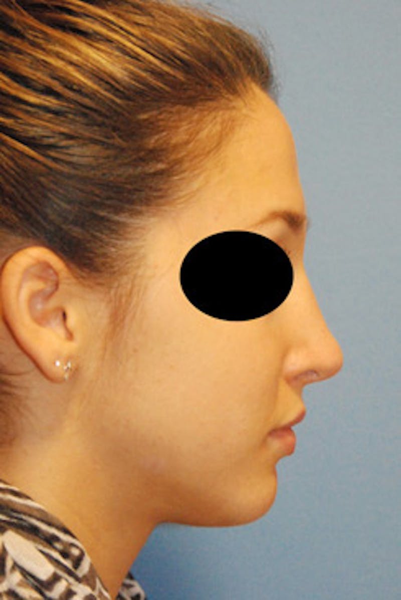 Rhinoplasty Before & After Gallery - Patient 353489 - Image 2