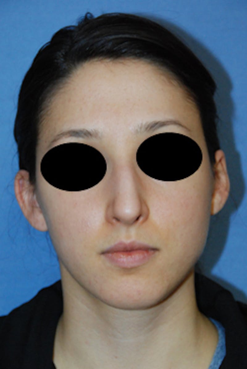 Rhinoplasty Before & After Gallery - Patient 353489 - Image 3