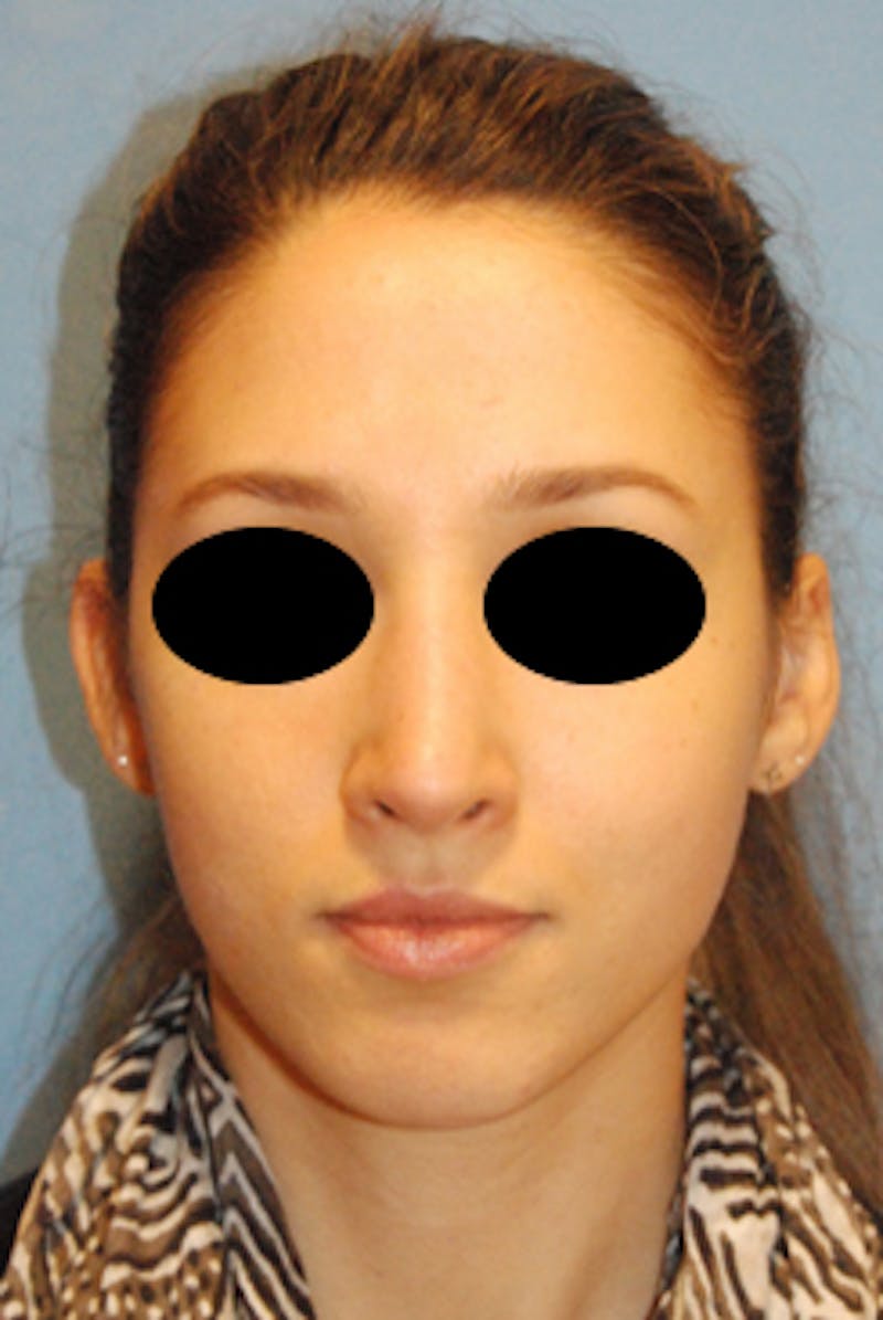Rhinoplasty Before & After Gallery - Patient 353489 - Image 4