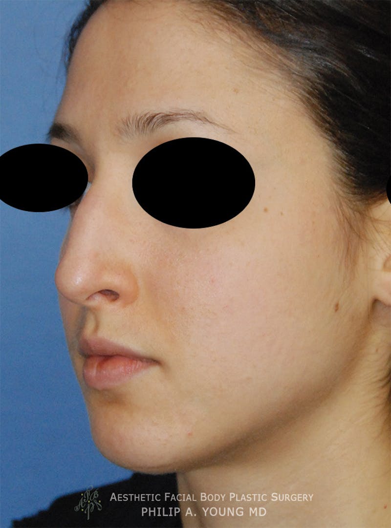 Rhinoplasty Before & After Gallery - Patient 353489 - Image 5