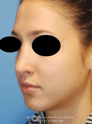 Rhinoplasty Before & After Gallery - Patient 353489 - Image 6