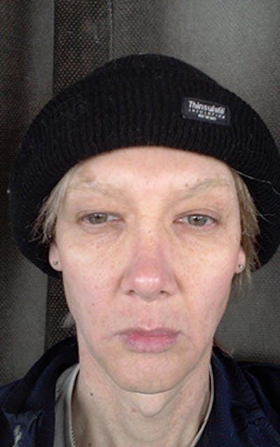 Rhinoplasty Before & After Gallery - Patient 302637 - Image 2